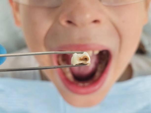Best Broken Tooth Emergency  in Decatur, GA